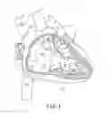 Fig. 02 - Interventional medical systems and associated methods