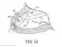 Fig. 12 - Interventional medical systems and associated methods