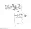 Fig. 09 - Leadless cardiac stimulation systems