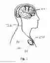 Fig. 02 - Method and apparatus for preventing or terminating epileptic seizures