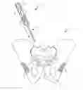 Fig. 01 - Implantable electrical stimulator with deflecting tip lead