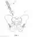 Fig. 02 - Implantable electrical stimulator with deflecting tip lead