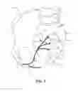 Fig. 04 - Implantable electrical stimulator with deflecting tip lead