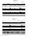 Fig. 05 - Non-invasive treatment of bronchial constriction
