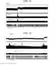 Fig. 09 - Non-invasive treatment of bronchial constriction