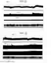 Fig. 15 - Non-invasive treatment of bronchial constriction