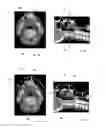 Fig. 04 - SYSTEM AND METHOD FOR DETERMINING THE POSITION OF OBJECTS IN A RADIATION ROOM FOR RADIATION THERAPY