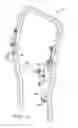 Fig. 12 - Operator protection apparatus with an over-center linkage