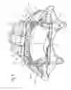 Fig. 07 - Disc brake and brake pad set
