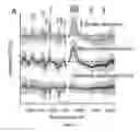 Fig. 06 - RAMAN SPECTROSCOPY SYSTEM, APPARATUS, AND METHOD FOR ANALYZING, CHARACTERIZING, AND/OR DIAGNOSING A TYPE OR NATURE OF A SAMPLE OR A TISSUE SUCH AS AN ABNORMAL GROWTH