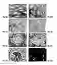 Fig. 15 - METHOD FOR DIAGNOSIS OF INFLAMMATORY DISEASES USING CALGRANULIN C