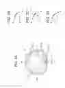 Fig. 09 - Truncated translating contact lens with optimized performance and method of design