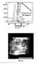 Fig. 13 - Method of manufacturing nano-scale LED electrode assembly comprising selective metal ohmic layer