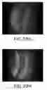 Fig. 62 - Apparatus, devices and methods for obtaining omnidirectional viewing by a catheter