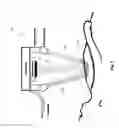 Fig. 06 - SYSTEMS AND METHODS FOR OPTICALLY GUIDED PLACEMENT AND MONITORING OF MEDICAL IMPLANTS