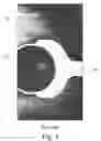 Fig. 02 - Compression and shielding device