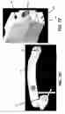 Fig. 11 - Tomosynthesis views from cone beam computed tomography data