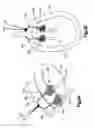 Fig. 88 - Methods for approximating a tissue defect using an anchor assembly