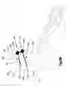 Fig. 91 - Methods for approximating a tissue defect using an anchor assembly