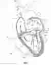 Fig. 02 - Mitral valve fixation device removal devices and methods