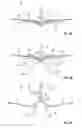 Fig. 04 - Mitral valve fixation device removal devices and methods