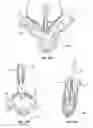 Fig. 10 - Mitral valve fixation device removal devices and methods