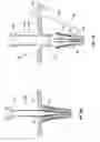 Fig. 21 - Mitral valve fixation device removal devices and methods