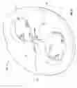 Fig. 24 - Mitral valve fixation device removal devices and methods