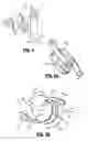 Fig. 05 - Surgical fastener appliers