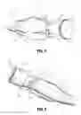 Fig. 06 - INSERTION SHROUD FOR SURGICAL INSTRUMENT