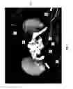 Fig. 06 - METHODS AND SYSTEMS FOR THERMOEMBOLIZATION
