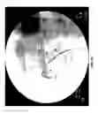 Fig. 11 - METHODS AND SYSTEMS FOR THERMOEMBOLIZATION