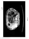 Fig. 12 - METHODS AND SYSTEMS FOR THERMOEMBOLIZATION