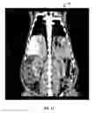 Fig. 13 - METHODS AND SYSTEMS FOR THERMOEMBOLIZATION