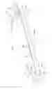 Fig. 03 - Bone cutting instrument with expandable section