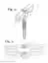 Fig. 03 - Polyaxial bone anchor with polymer sleeve