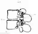 Fig. 09 - Distraction/compression posterior rod system and methods of use