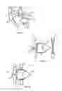 Fig. 11 - Spinous process fusion devices