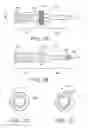 Fig. 10 - Nail System and Method for an Olecranon Osteotomy