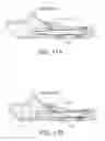 Fig. 21 - Nail System and Method for an Olecranon Osteotomy