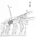 Fig. 18 - Bone plate system and method