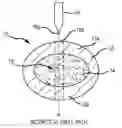 Fig. 01 - Unicortical path detection for a surgical depth measurement system