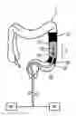Fig. 01 - Devices, systems, and methods for treating ulcerative colitis and other inflammatory bowel diseases