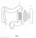 Fig. 02 - Devices, systems, and methods for treating ulcerative colitis and other inflammatory bowel diseases
