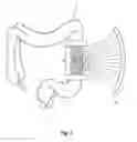 Fig. 03 - Devices, systems, and methods for treating ulcerative colitis and other inflammatory bowel diseases