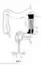 Fig. 04 - Devices, systems, and methods for treating ulcerative colitis and other inflammatory bowel diseases