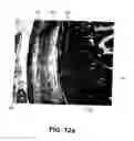 Fig. 06 - Method for selectively elevating and separating tissue layers and surgical instrument for performing the method