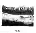 Fig. 12 - Method for selectively elevating and separating tissue layers and surgical instrument for performing the method