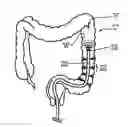 Fig. 01 - APPARATUSES, SYSTEMS AND METHODS FOR TREATING ULCERATIVE COLITIS AND OTHER INFLAMMATORY BOWEL DISEASES
