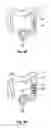 Fig. 06 - APPARATUSES, SYSTEMS AND METHODS FOR TREATING ULCERATIVE COLITIS AND OTHER INFLAMMATORY BOWEL DISEASES